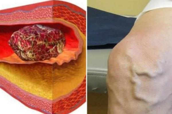 RUSKI RECEPT NE RASTVARA TROMB, U PITANJU JE LAŽ