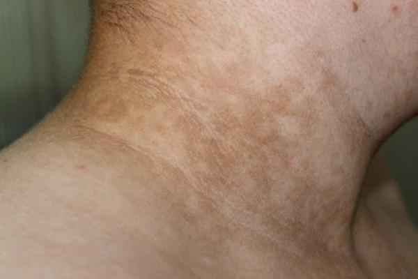 AKO IMATE OVE FLEKE PO VRATU BRZO KOD LEKARA! Možda PATITE od NEIZLEČIVE BOLESTI. Ovo su simptomi