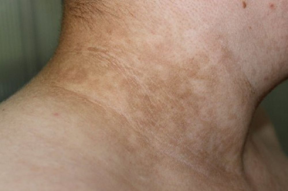 AKO IMATE OVE FLEKE PO VRATU BRZO KOD LEKARA! Možda PATITE od NEIZLEČIVE BOLESTI. Ovo su simptomi