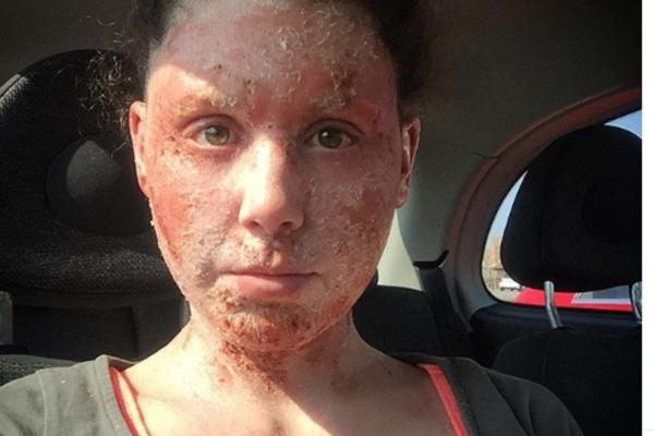 ZOVU JE DEVOJKA GUŠTER: Zbog užasne bolesti ne može da ima odnose sa dečkom, a lečenje joj izaziva ZAVISNOST