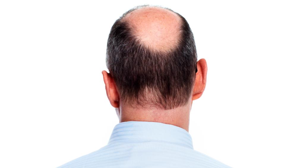 Ćelavost može biti znak srčanog oboljenja 