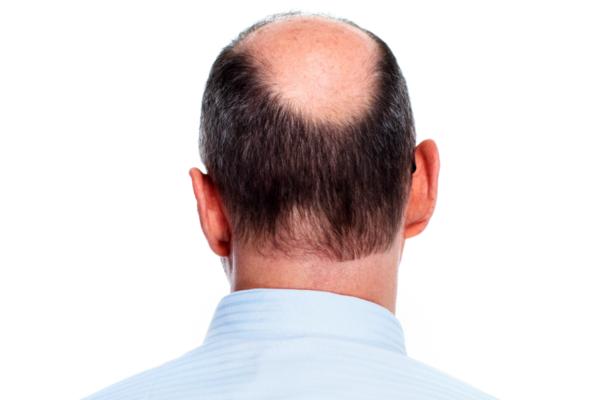 ĆELAVOST KOD MUŠKARACA MOŽE DA SE ZAUSTAVI: Ovo su DVA ključna koraka!