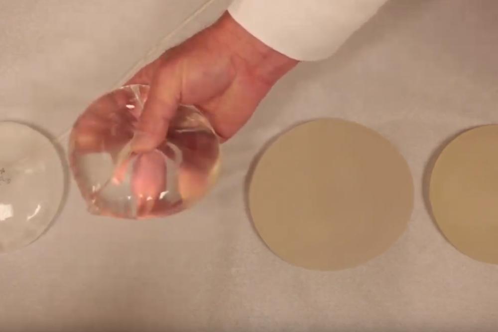 70.000 ŽENA JE UGRADILO SILIKONE KOJI IZAZIVAJU RAK: U Francuskoj su implanti koji ovako izgledaju - ZABRANJENI!