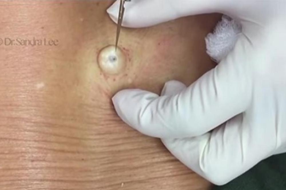 Imala je čudnu KVRŽICU na leđima godinama, a kada je doktorka napravila REZ izašlo je nešto što niko nije OČEKIVAO!