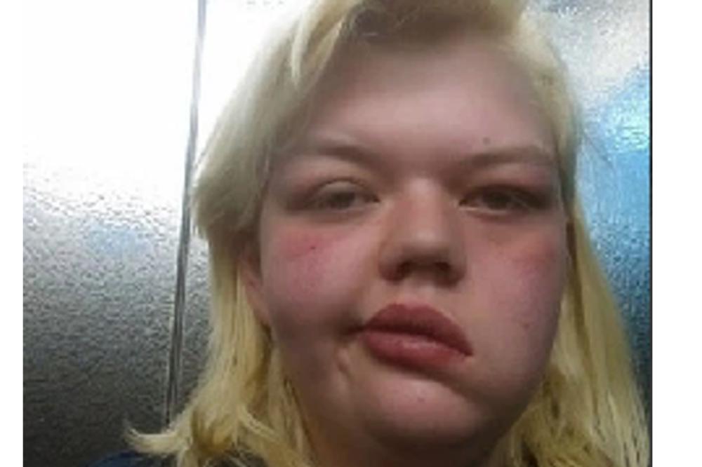 NEĆU DA MOJE DETE MALTRETIRAJU ZBOG MOJE PARALIZE LICA: Sada se plaši da ćerku odvede u vrtić! (FOTO)