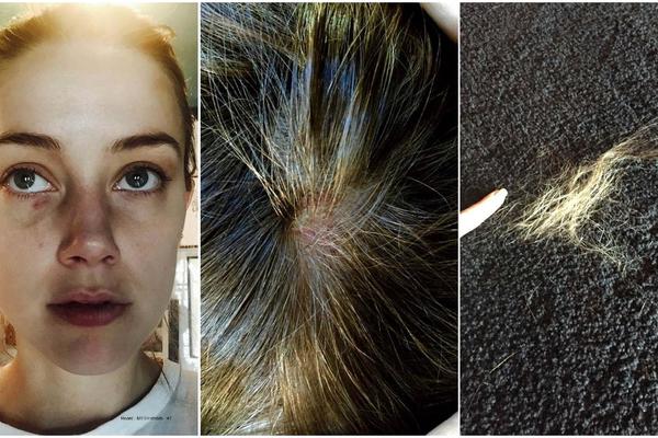 DŽONI DEP POSLE SRBIJE PRAVO U ZATVOR! Bivša žena objavila JEZIVE slike zlostavljanja i podnela tužbu protiv GLUMCA