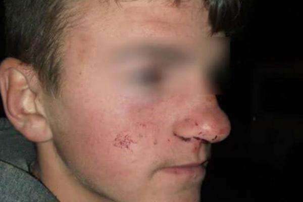 POJAVILE SE SLIKE DEČAKA KOJEG JE PRETUKAO BIVŠI POLICAJAC: Naredio im da legnu uz pretnju pištoljem, pa...