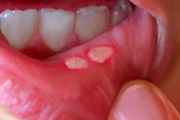 TRPELA BOLOVE ZBOG AFTE U USTIMNA PA... Sve više obolelih mladih ljudi - devojci ODSEKLI JEZIK, a imala 1 SIMPTOM