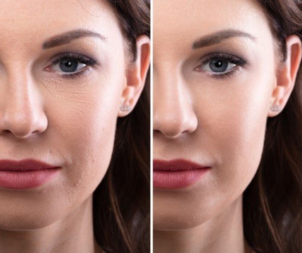 Bore, Lice, Starenje, Podmlađivanje