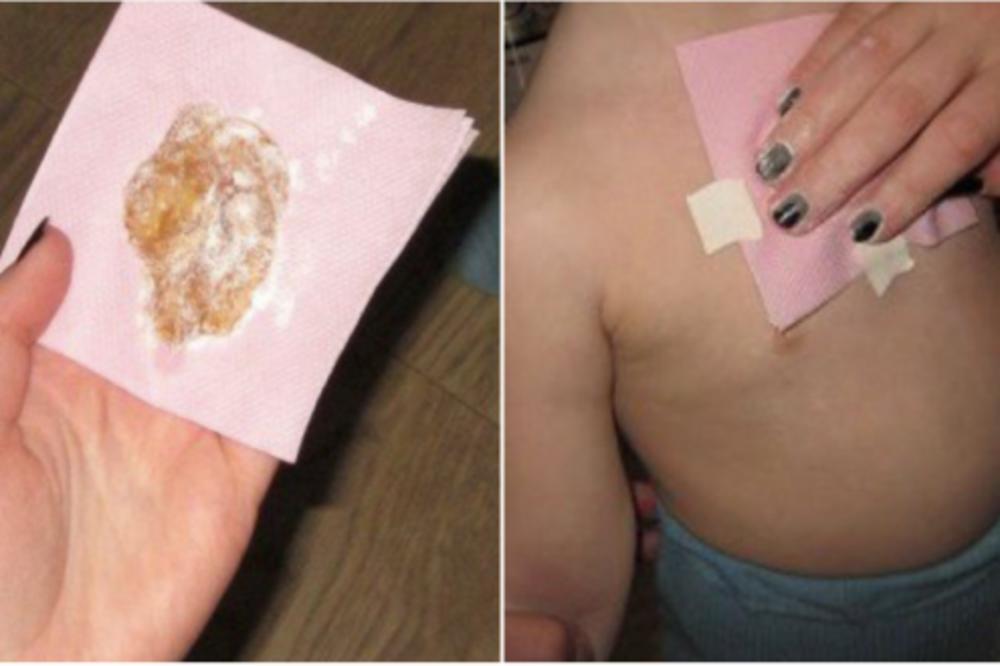 PRODISAĆETE VEĆ NAKON PRVE OBLOGE! Ovo je recept za spas od dosadnog kašlja! DELUJE ODMAH