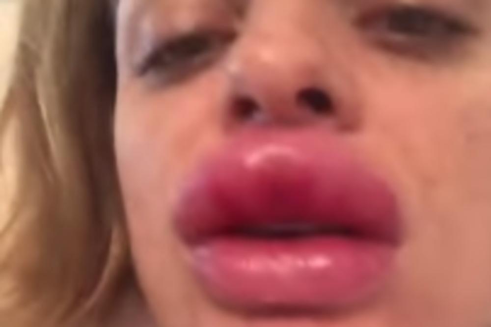 DEVOJKA JE UGRADILA FILERE PA GADNO ZAŽALILA: Ujutro kad se probudila zgrozila se!