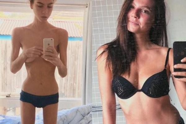 IMALA SAM SAMO 36 KILOGRAMA: Saša je bila anoreksična, a ovako je tekla njena borba