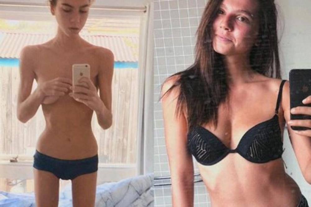 IMALA SAM SAMO 36 KILOGRAMA: Saša je bila anoreksična, a ovako je tekla njena borba