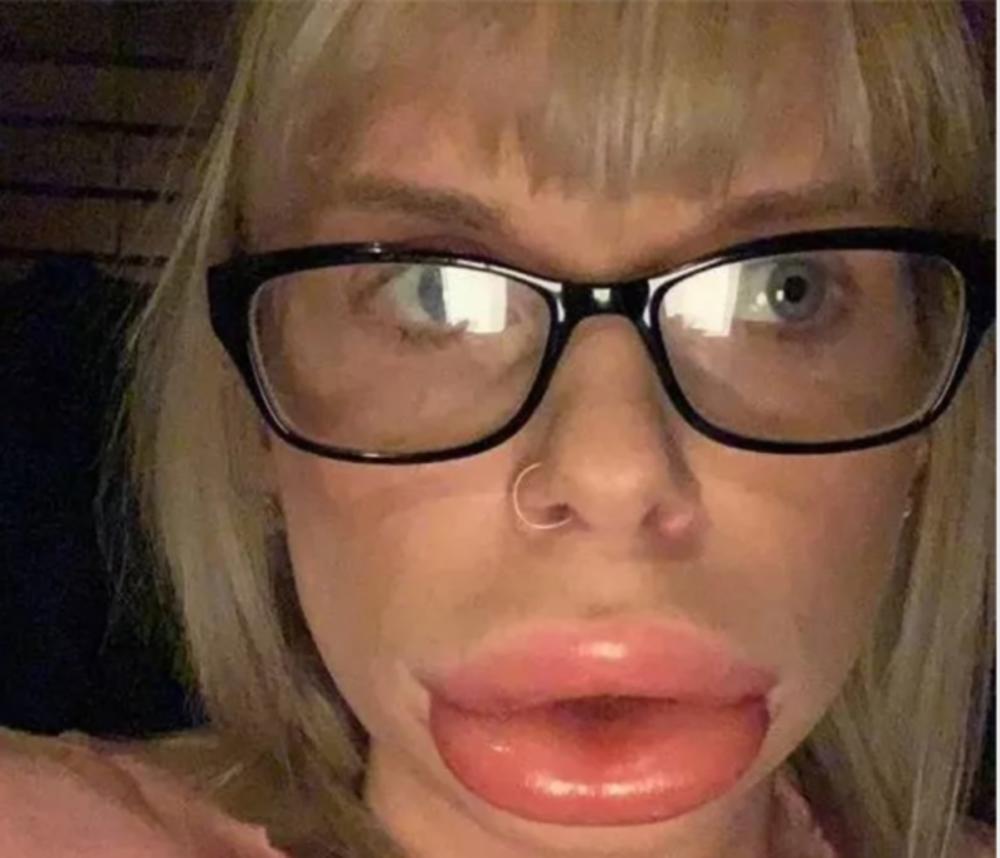 Kristina Burton posle intervencije  