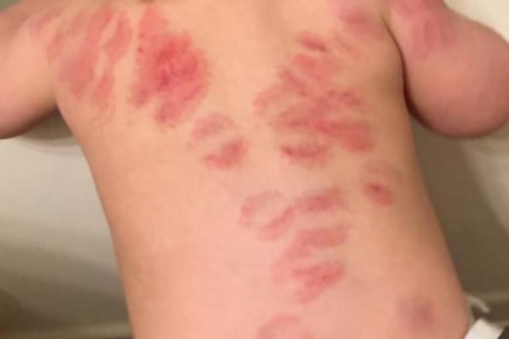 ĆERKA SE IZ VRTIĆA VRATILA SA STRAŠNIM POVREDAMA NA LEĐIMA: Kada je shvatila od čega su, majka je sve prijavila