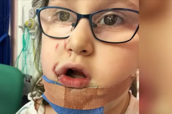 PAS NAPAO AUTISTIČNU DEVOJČICU, ODGRZAO JOJ POLA USNE! Ožiljci će joj ostati doživotno (VIDEO)