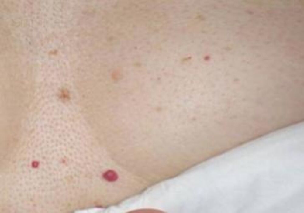 Kod većine slučajeva, apsolutno je nepotrebno uklanjati ih jer su to bezopasni kožni tumori