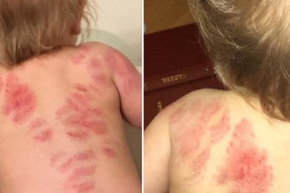 MAJKA SE RASPLAKALA KADA JE VIDELA ĆERKU Poslala je u jaslice, pa DOŽEVELA FRAS zbog UGRIZA koje je devojčica imala