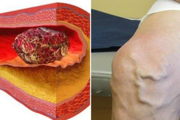 OVO JE PRVI SIMPTOM TROMBA U NOZI! Ako ga ignorišete, posledice mogu biti JEZIVE