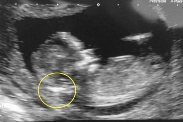 LEKAR NA ULTRAZVUKU PRIMETIO NEOBIČNU POJAVU NA BEBI: Uskoro su saznali da u njoj ŽIVI nešto neverovatno!