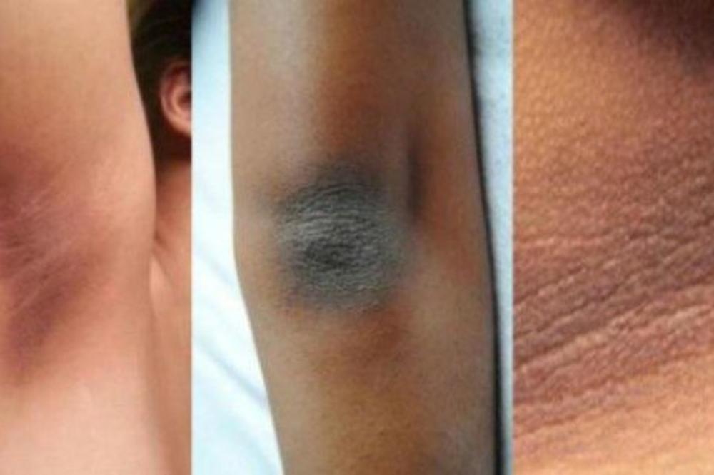 PREGLEDAJTE DETALJNO SVOJE TELO I OBRATITE PAŽNJU: Ove promene na koži ukazuju na NAJOZBILJNIJE probleme!