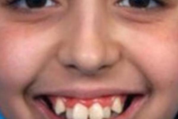 BILA JE RUŽNO PAČE: Izmenili su joj CELU VILICU i pretvorili u pravu LEPOTICU! POGLEDAJTE KAKO IZGLEDA SADA