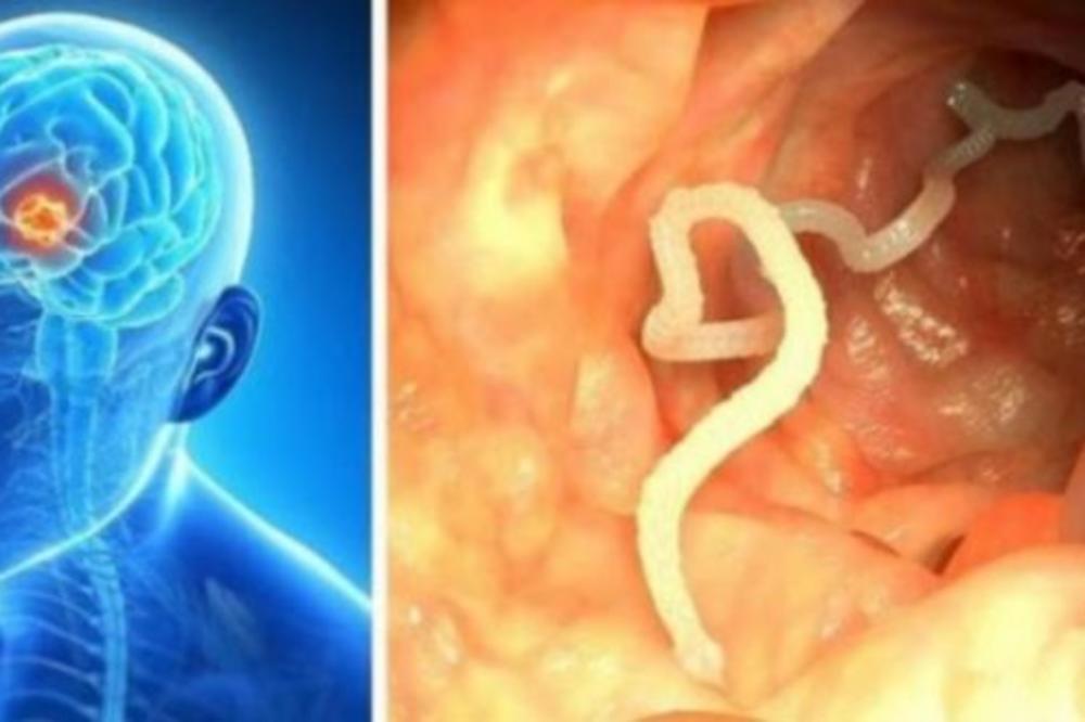 OVA HRANA MOŽE IZAZVATI POJAVU CRVA U MOZGU: Šokantne informacije su zabrinule CELU PLANETU! OVO JE UŽAS!