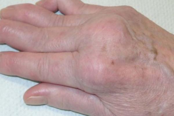 OVU HRANU JEDEMO STALNO, A IZAZIVA OPASNU BOLEST: Sadrži bakteriju koja ubrzava REUMU!