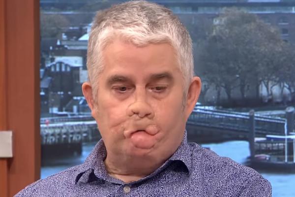 NAKON POSETE ZUBARU PAO JE U KOMU! Zbog opake bolesti odsekli su mu udove - sada ima važno UPOZORENJE za sve