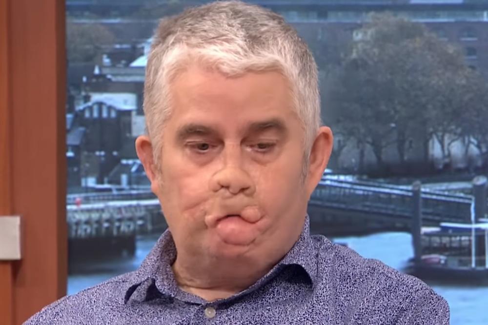 NAKON POSETE ZUBARU PAO JE U KOMU! Zbog opake bolesti odsekli su mu udove - sada ima važno UPOZORENJE za sve