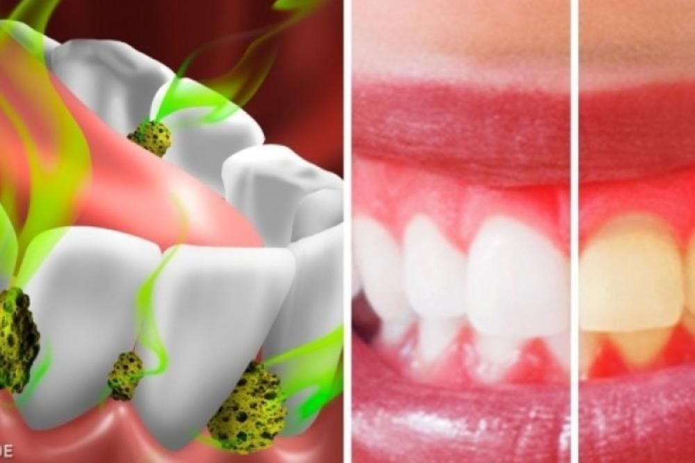 ZBOG OVE BAKTERIJE VAM SMRDI IZ USTA: Samo JEDAN TRIK je potreban da to nestane, IZ USTA ĆE VAM MIRISATI RUŽE!
