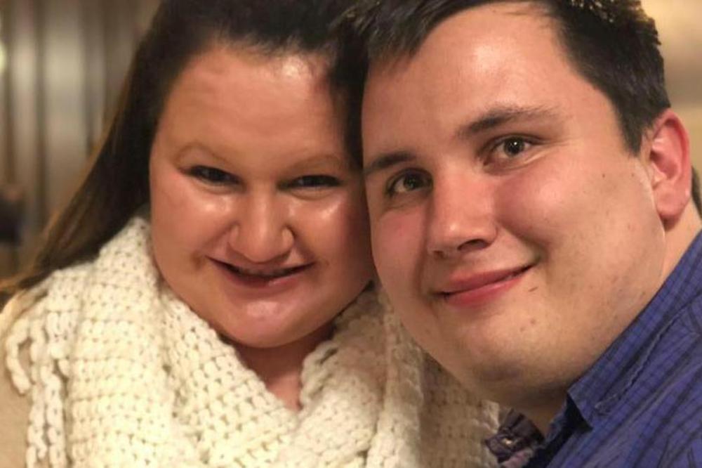 DEVOJKA SE ZBOG OPAKE BOLESTI POLAKO PRETVARA U KAMEN! Sva tkiva u njenom telu postaju KOSTI, a leka nema (FOTO)