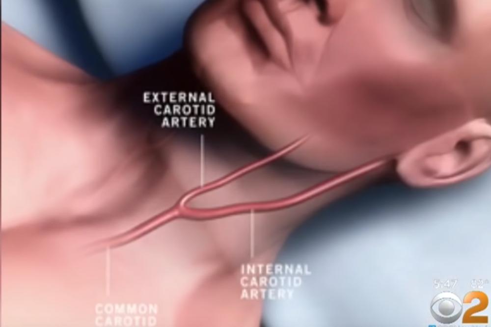 ZA VREME VEČERE DOBIO MOŽDANI UDAR I UMRO: Uzrok tome je ŠOKIRAO I DOKTORE! Pa ovo svi radimo! (VIDEO)