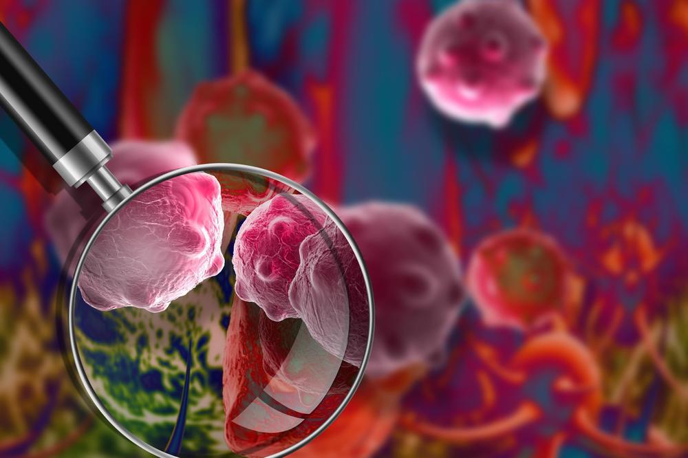 MULTIPLI MIJELOM JE MALIGNO OBOLJENJE: Svaki pacijent ima drugačiju kombinaciju simptoma, JEDAN JE POSEBNO VAŽAN!