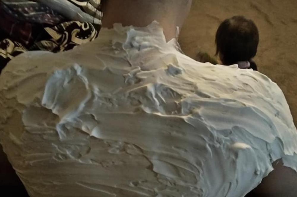 ZABORAVITE NA JOGURT: Najbolji LEK ZA OPEKOTINE je preparat koji sigurno imate u kući!