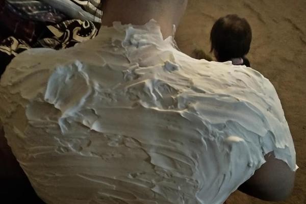 MAJKA JE OTKRILA TRIK GODINE! Samo na jedan način opekotine od sunca će nestati za POLA SATA! JOGURT NE POMAŽE