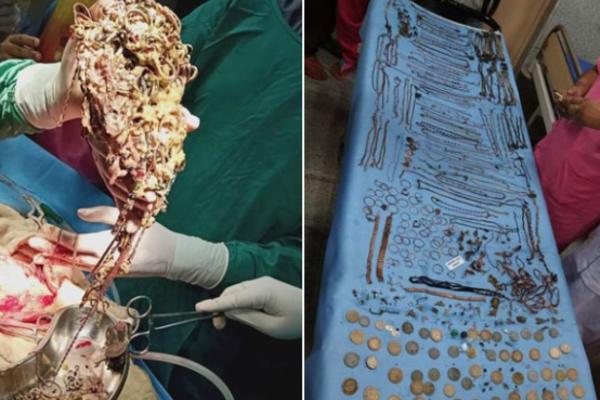 ŽENI SU IZ ŽELUCA IZVADILI 1,6 KILOGRAMA ZLA NAKITA I NOVČIĆA! Imala je OVE simptome kad je otišla kod lekara!
