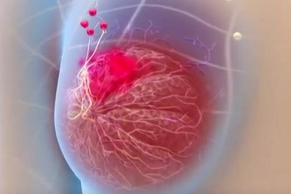 OTKRILI SU JOJ RAK, A IMALA JE SAMO JEDAN SIMPTOM: Ovo je njeno iskustvo koje želi da podeli sa svima!