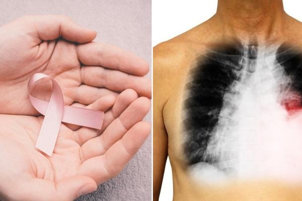 SVETSKI DAN BORBE PROTIV RAKA PLUĆA, NAJČEŠĆEG I NAJSMRTONOSNIJEG KARCINOMA U SRBIJI I SVETU