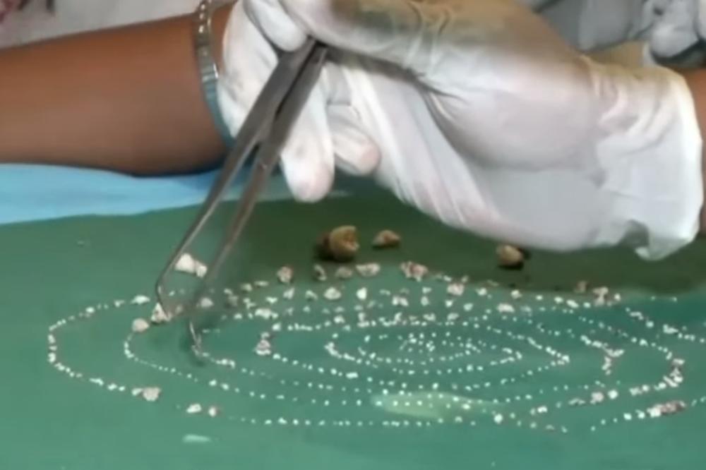 IZVADILI VIŠE OD 500 ZUBA IZ USTA DEČAKA (7): Ovo nije ZABELEŽENO u istoriji! (VIDEO)