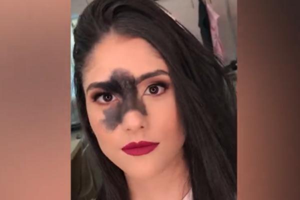 OVA BRAZILKA RUŠI SVE PREDRASUDE O LEPOTI: Uprkos  ogromnom mladežu na licu, postala je uspešna manekenka! (VIDEO)