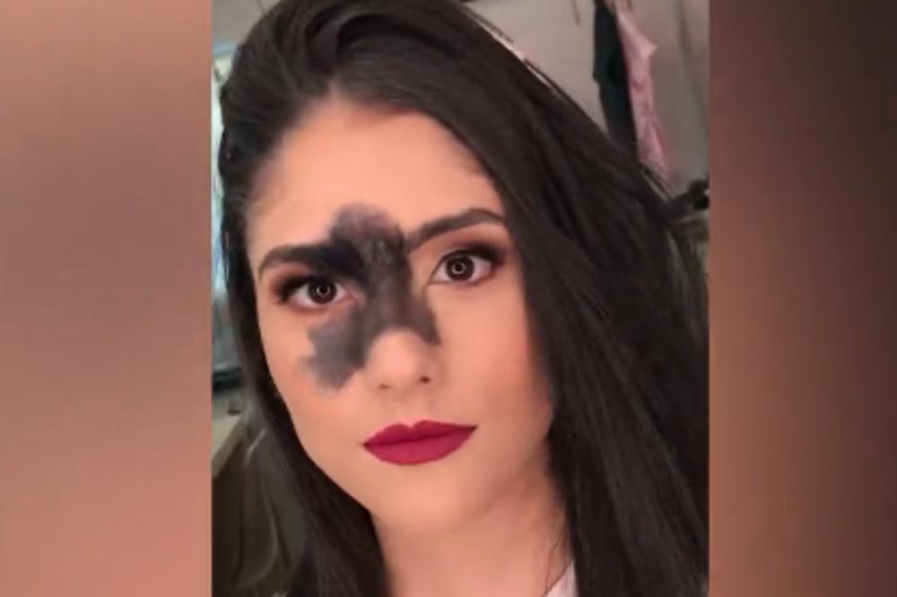 OVA BRAZILKA RUŠI SVE PREDRASUDE O LEPOTI: Uprkos  ogromnom mladežu na licu, postala je uspešna manekenka! (VIDEO)