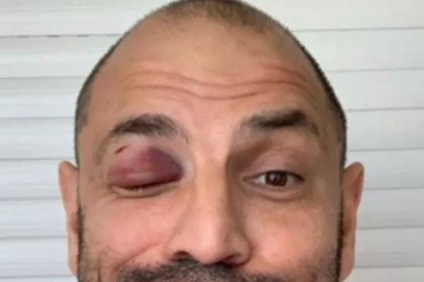 ZVONKO MARKOVIĆ ŽRTVA NASILJA! Jutros u 5 NAPADNUT: Objavio fotografiju UŽASA na Instagramu