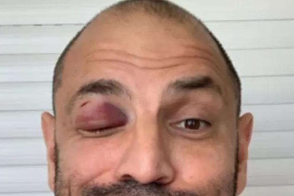 ZVONKO MARKOVIĆ ŽRTVA NASILJA! Jutros u 5 NAPADNUT: Objavio fotografiju UŽASA na Instagramu