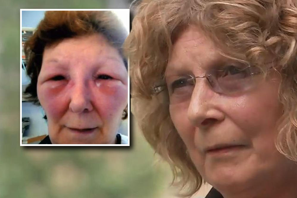 OVA ŽENA UMALO JE UMRLA ZBOG LAŽNOG HIRURGA SA FEJSBUKA: Posle lošeg botoksa izgleda kao Frankenštajn (FOTO)