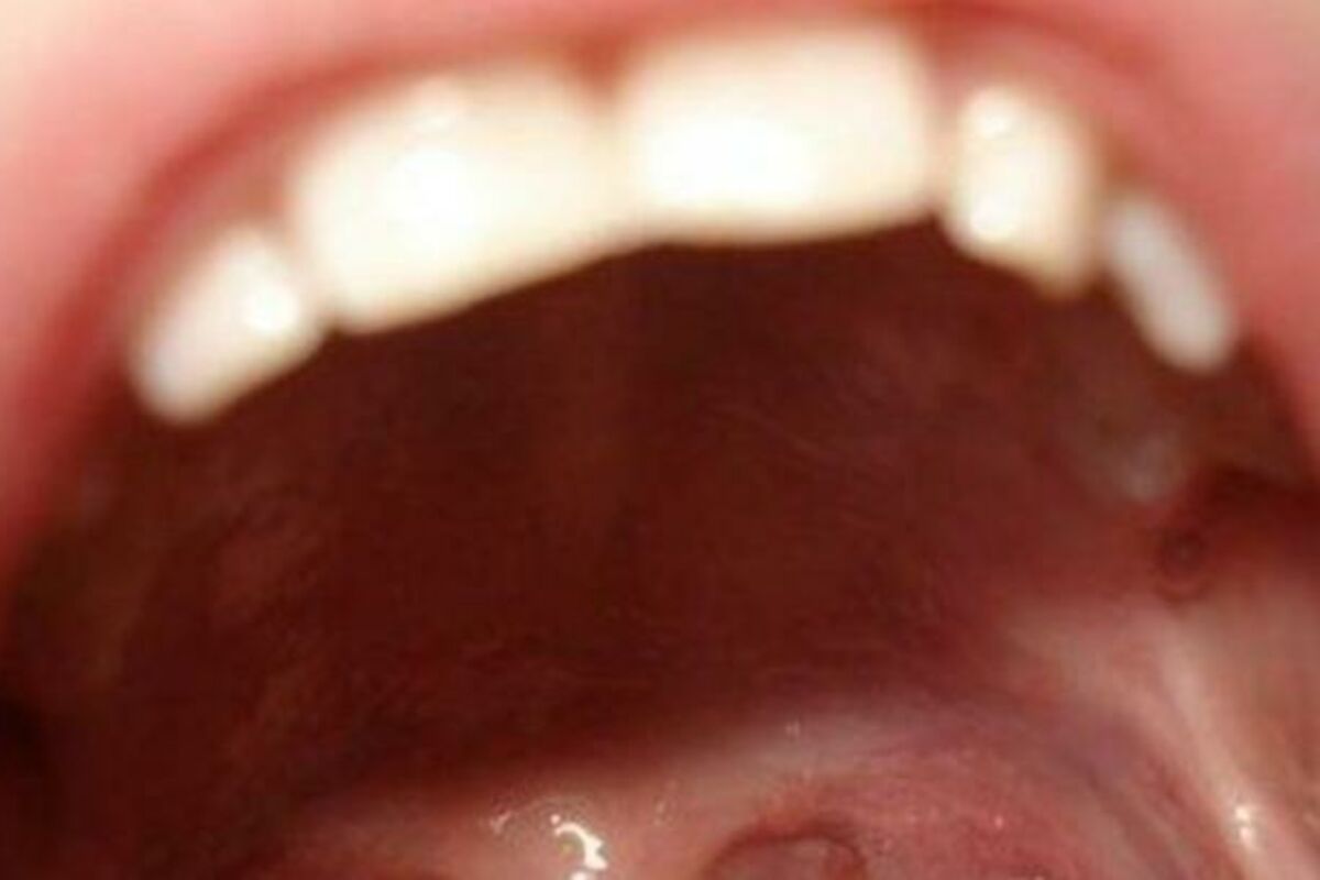 humani papiloma virus u ustima crema pentru papiloame pe intim