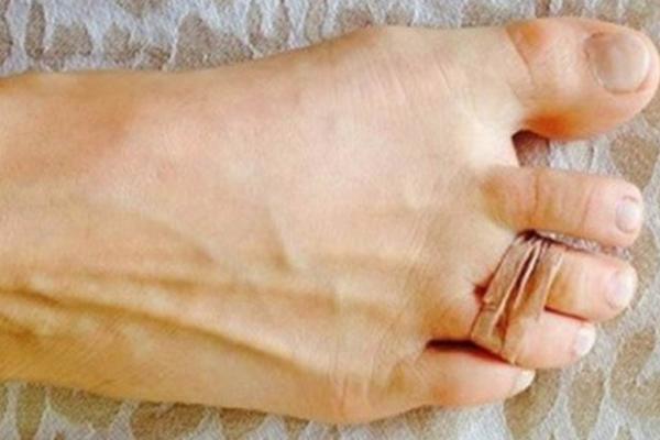 SVAKOG JUTRA JE STAVLJALA GUMICU OKO DVA NOŽNA PRSTA: Razlog će svakoj ženi spasiti dan! (VIDEO)