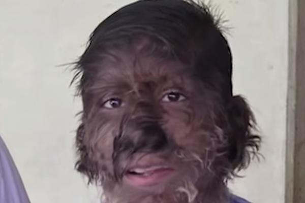 DECA SE ZBOG LEKOVA PRETVORILA U VUKODLAKE! Roditelji primetili da im rastu dlake svuda, a onda je otkriven UZROK