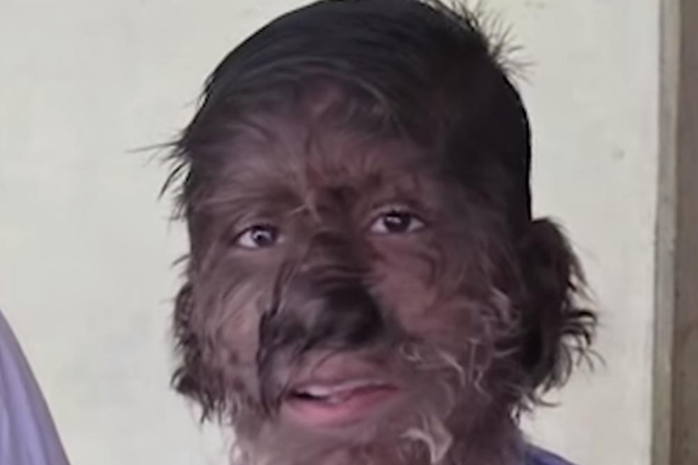 DECA SE ZBOG LEKOVA PRETVORILA U VUKODLAKE! Roditelji primetili da im rastu dlake svuda, a onda je otkriven UZROK