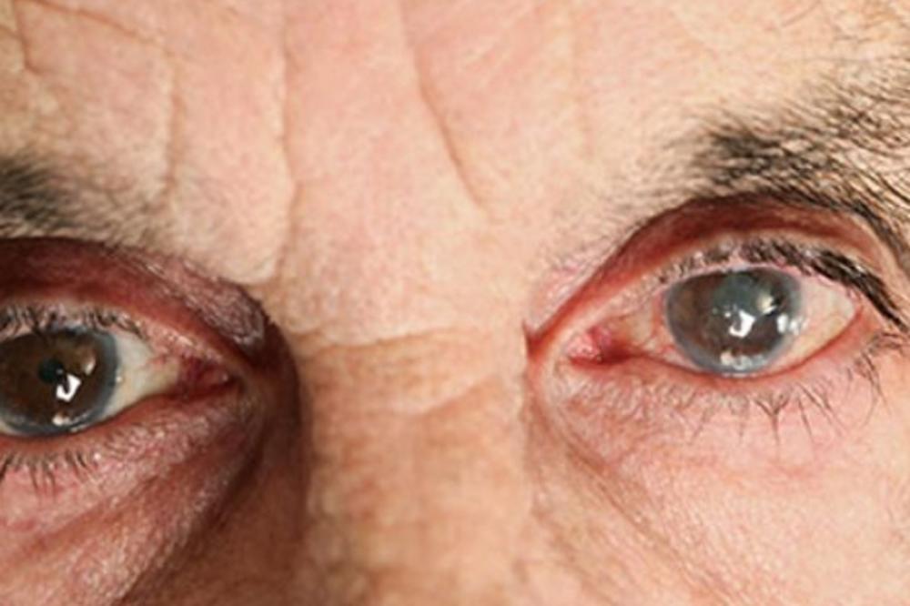 NE, NE POSTOJI DOMAĆI RECEPT KOJI LEČI OČNE BOLESTI